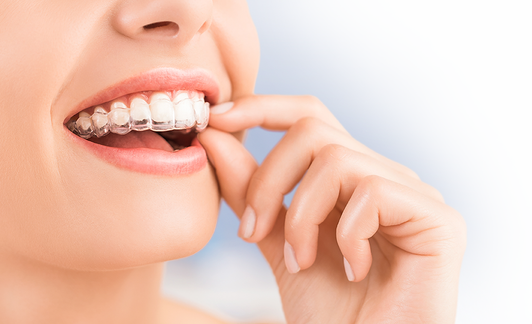Invisalign in Beckenham