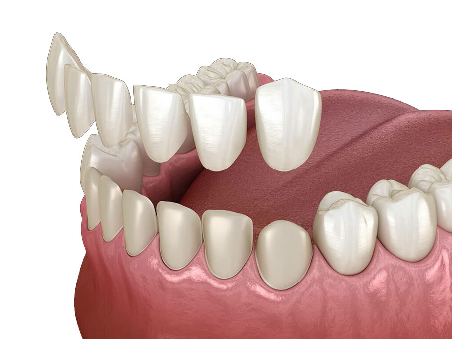 Veneers in Beckenham