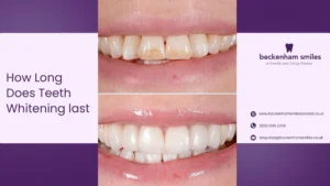 How-Long-Does-Teeth-Whitening-Last-in-Beckenham-Expert-Guide-to-Results-Maintenance-Penge