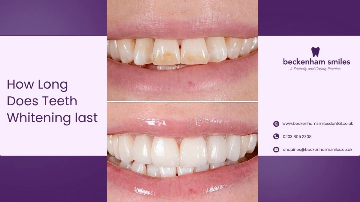 How-Long-Does-Teeth-Whitening-Last-in-Beckenham-Expert-Guide-to-Results-Maintenance-Penge