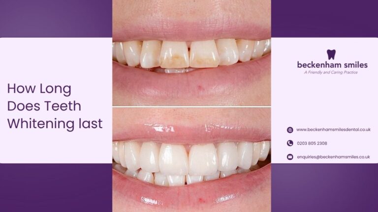 How Long Does Teeth Whitening Last in Beckenham?