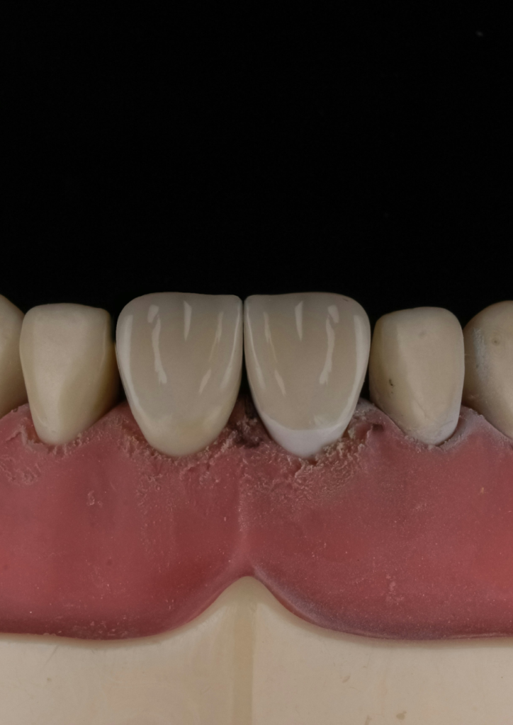 Cosmetic dental smile design showing improved gum line and natural looking teeth