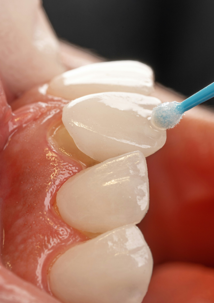 Natural looking cosmetic dental veneers improving smile appearance and tooth alignment