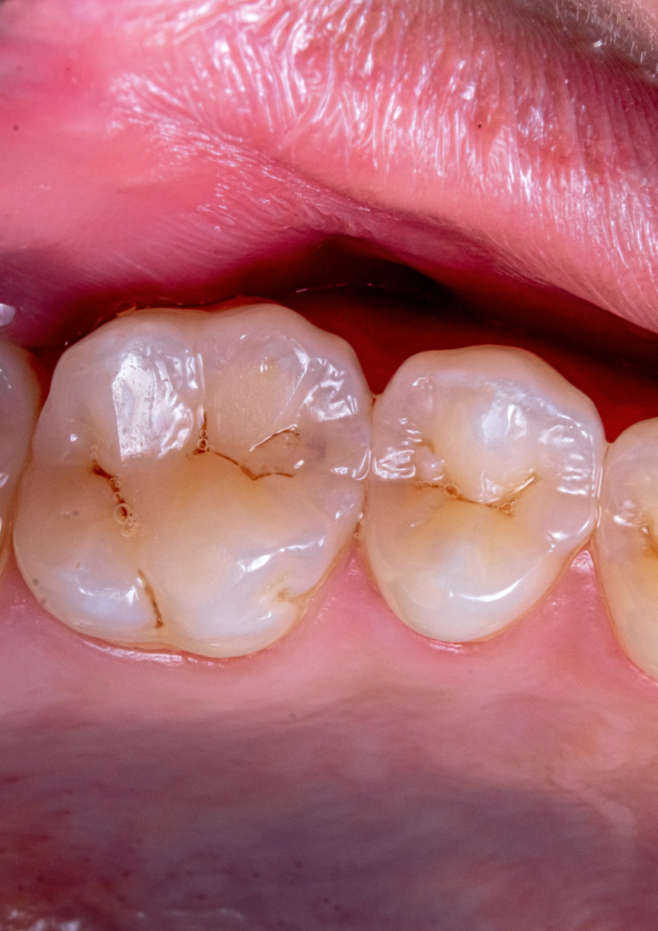 Close-up of a restored molar tooth after cosmetic dental restoration treatment