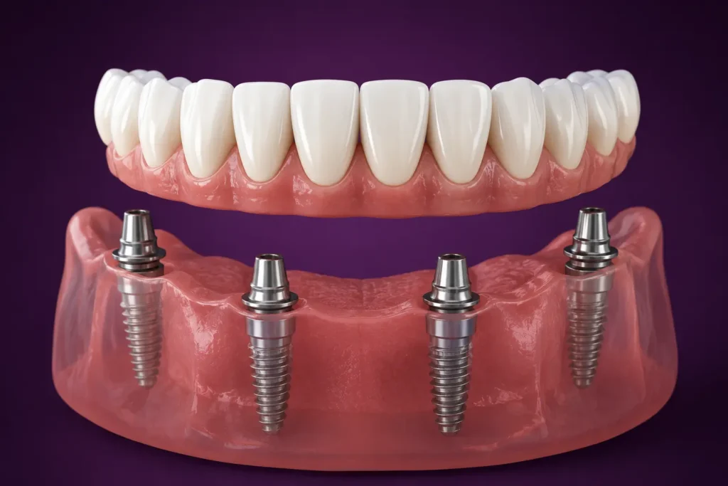 All-on-4 dental implants treatment in Beckenham for full smile restoration