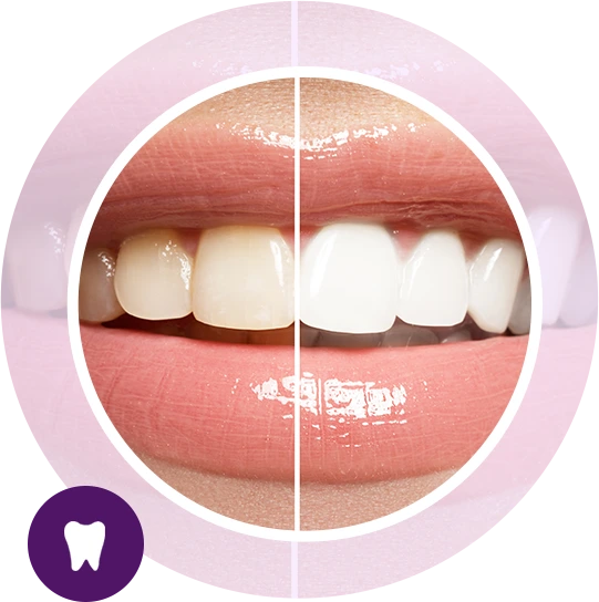 Before and after results of a cosmetic smile makeover treatment in Beckenham dental clinic