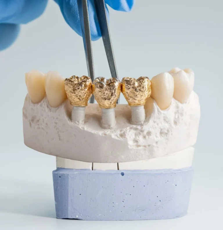 Dental crowns in Beckenham