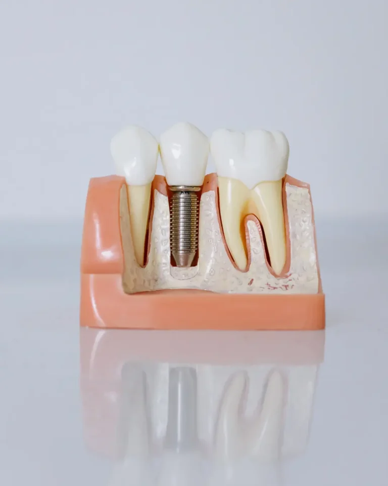 dental implants backenham smiles